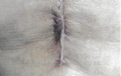 CICATRICI
